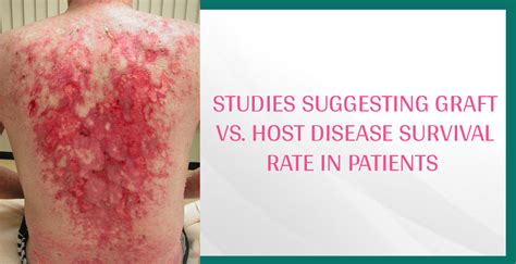 Graft Vs Host Disease Survival Rate In Patients