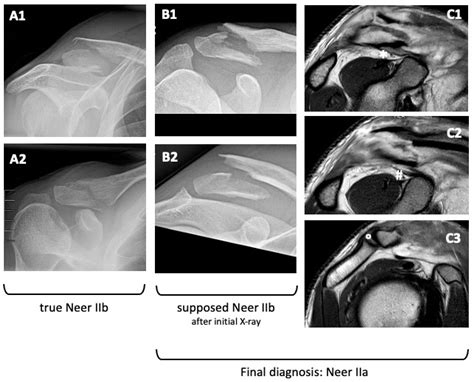 Jcm Free Full Text The Accuracy Of Distal Clavicle Fracture