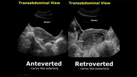 uterine positions in ultrasound anteverted retroverted anteflexed retroflexed uterus youtube