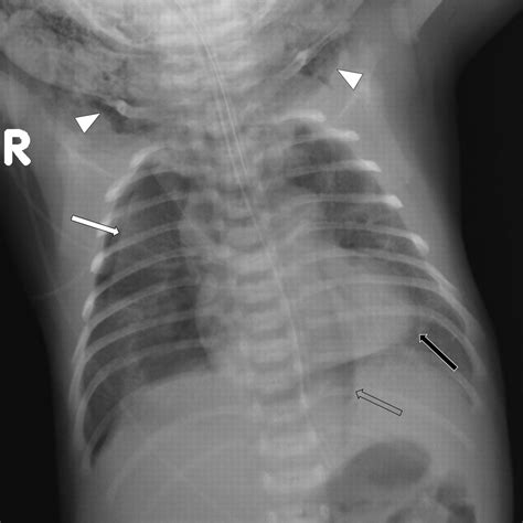 Tension Pneumomediastinum With Subcutaneous Emphysema Adc Fetal