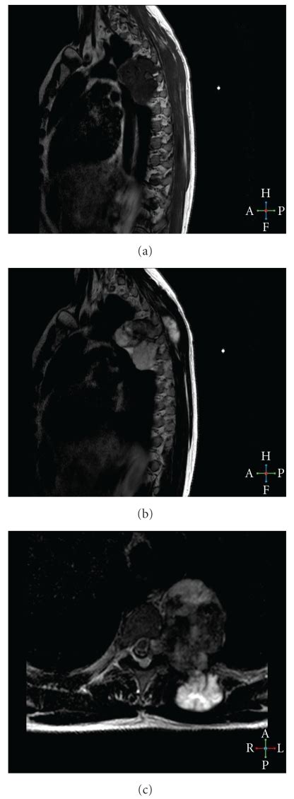 The Sagittal T1 W A Mr Image Shows A Hypointense Lobulated Lesion