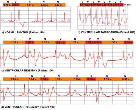 Some ECG Patterns A Normal Sinus Rhythm B Ventricular Tachycardia