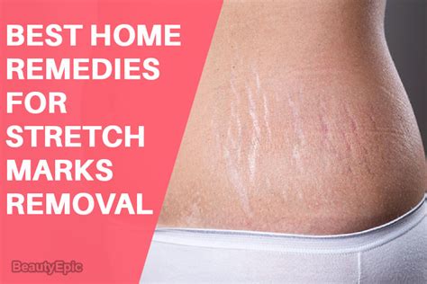 Home Remedies For Stretch Marks 8 Easy To Remove Stretch Marks