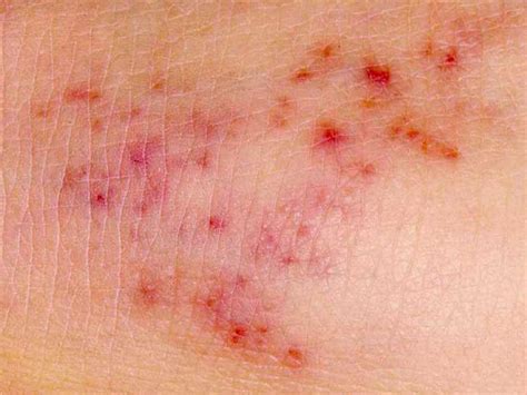 A viral rash is any rash caused by an infection with a virus. Meningitis rash: Pictures, symptoms, and similar rashes