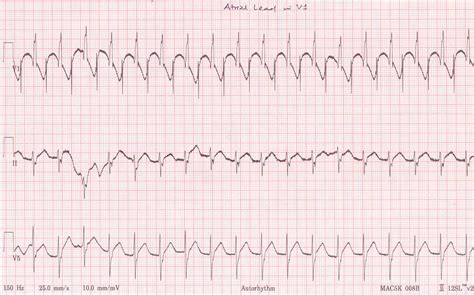 Pedi Cardiology ICU EKG Junctional Rhythm Atrial Lead EKG