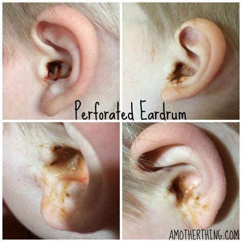 Collection 96 Images Pictures Of A Ruptured Eardrum Latest
