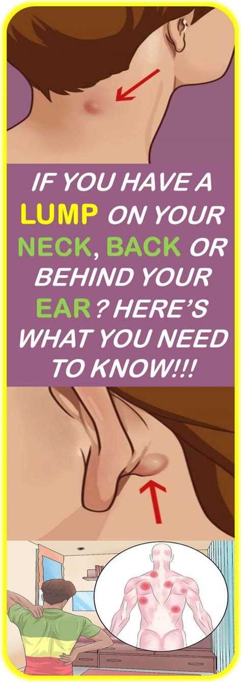 If You Have A Lump On Your Neck Back Or Behind Your Ear Heres What