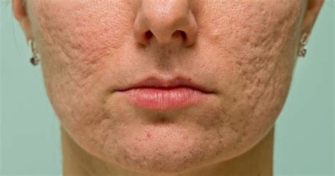 What Are Different Type Of Acne Scars