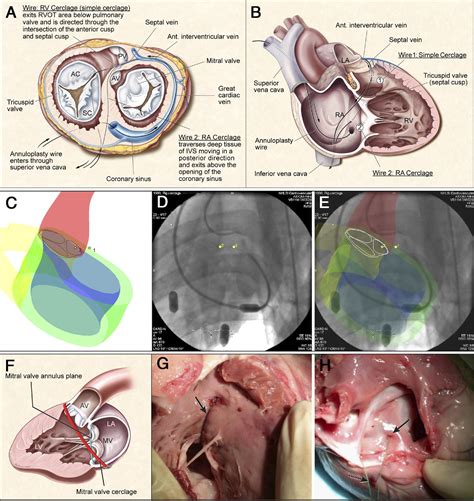 Mitral Cerclage Annuloplasty A Novel Transcatheter Treatment For