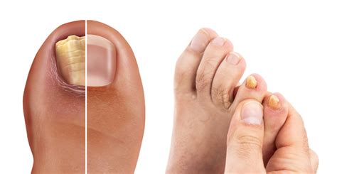 Best Fungal Nail Treatment Podiatrist Melbourne Sole Motion