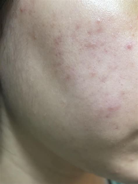 Acne Routine Help Help Getting Rid Of This Type Of Cheek Acne Had