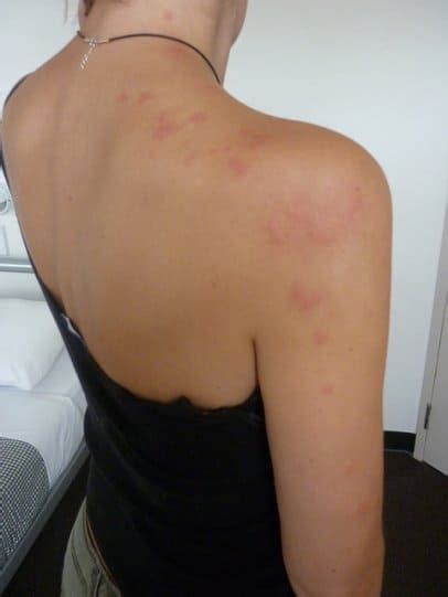 Pictures Of Bed Bugs Bites On Real People Debedbug