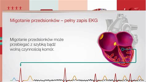 Choroby serca i naczyń Migotanie przedsionków Zdrowie Bayer