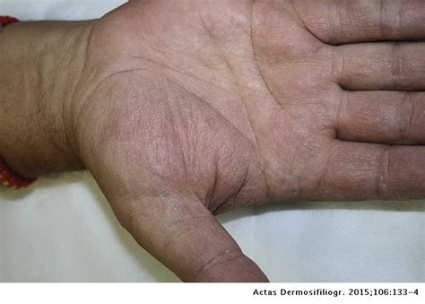 Dyshidrotic Eczema Nail Bed Nail Ftempo