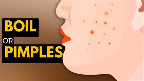 Boils Vs Pimples Whats The Difference And How To Treat Them Youtube