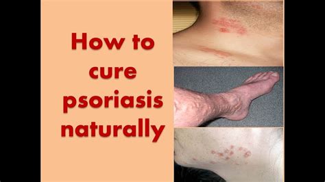 How To Cure Psoriasis Naturally Youtube