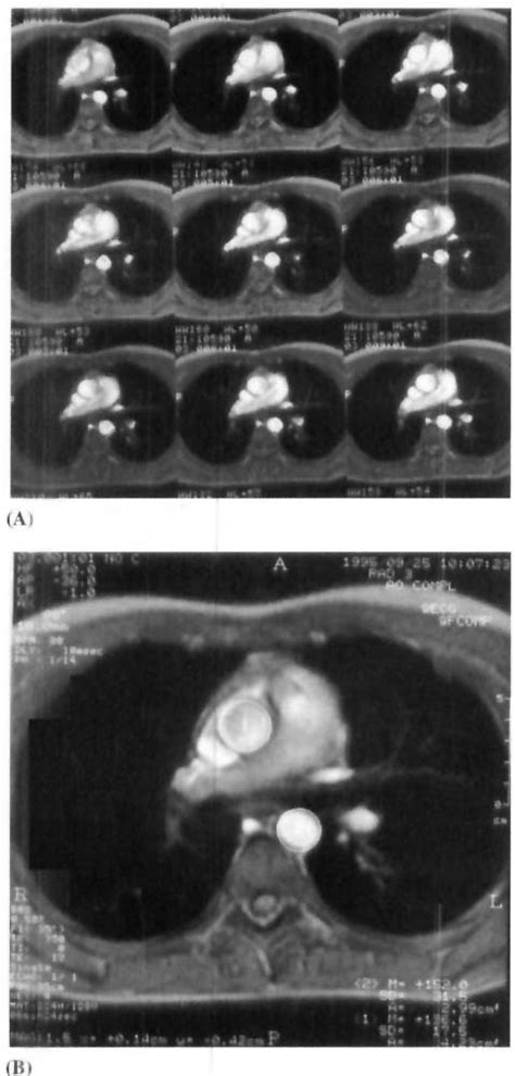 Axial Gradient Echo Image Of The Thoracic Aorta In The Mid Ascending