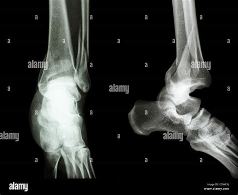 Film X Ray Ankle Aplateral Show Fracture Distal Tibia And Fibula