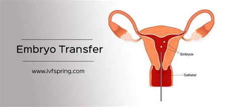 Know The Dos And Donts After Embryo Transfer Ivf