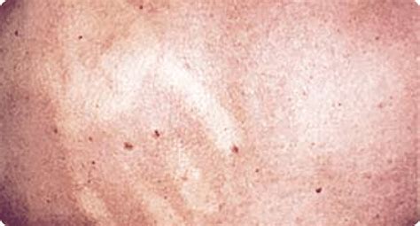 An outbreak of rashes following the onset of dengue fever brings with it a number of complications. Indistinct macular/scarlatini-form skin rash seen with ...