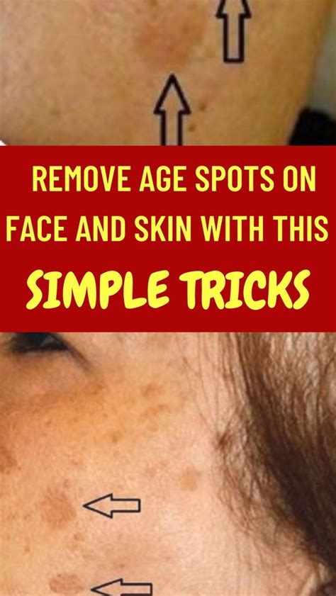 Best Home Remedies To Remove Remove Age Spots Age Spots On Face Age Spot Removal Spots On Face