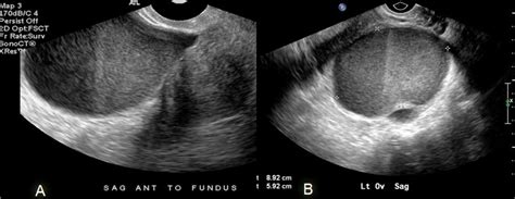 Figure 1 From Sonographic Features Of Tubo Ovarian Abscess Mimicking An
