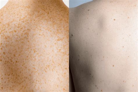 Freckles Vs Moles Understanding The Difference
