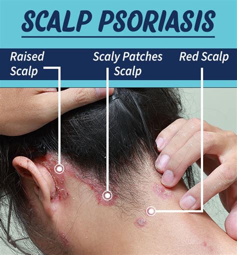 Scalp Pain And Hair Loss Offer Online Save 61 Jlcatjgobmx