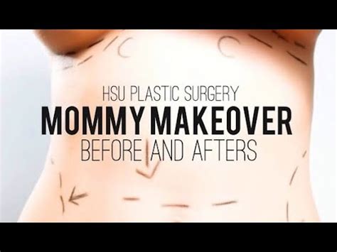 Mommy Makeover Patient Before And Afters YouTube