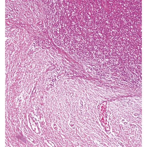 Dissecting Cellulitis Of The Scalp A Inflamed Granulation Tissue And