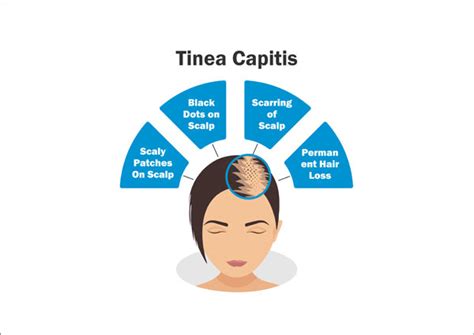 Tinea Capitis Symptoms Causes Treatment And Prevention Richfeel