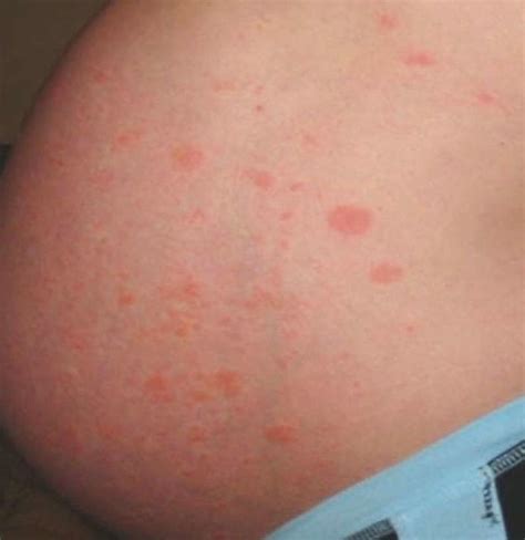 What Causes Skin Rash In Pregnancy Printable Templates Protal
