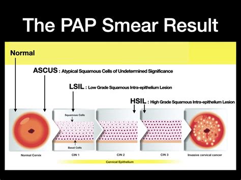Ascus Pap Smear And Hpv Anthony Siow