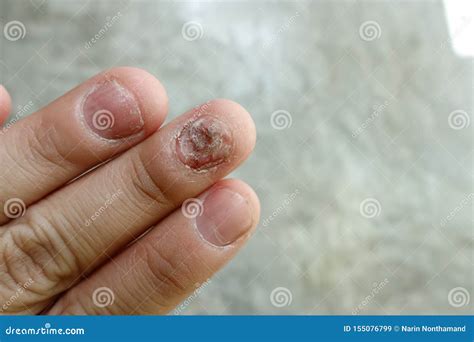 Close Up Of Fungus Nail Infection Fungal Infection On Nails Hand