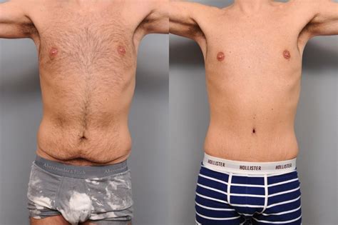 Tummy Tuck For Men In Nyc Dr Thomas Sterry