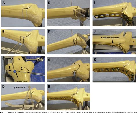 Figure 2 From A Novel Closed Wedge High Tibial Osteotomy Procedure To