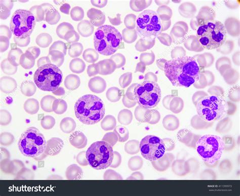 Neutrophil Cell White Blood Cell In Peripheral Royalty Free Stock