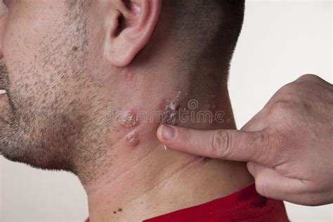 Raised Red Bumps And Blisters Caused By The Shingles Virus Stock Photo