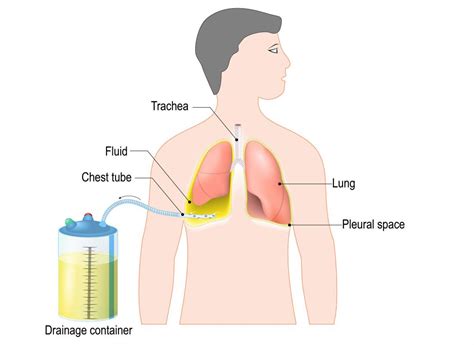Chest Tube Insertion Uses Procedure And Recovery