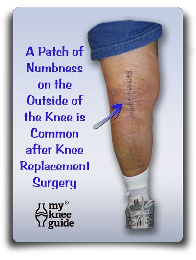 Knee Numbness A Common Post Operative Finding Knee Replacement Knee