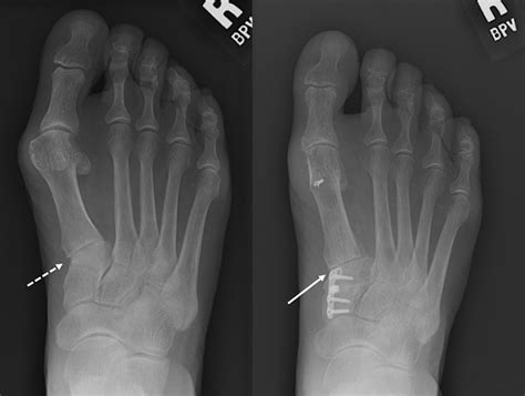 Medial Cuneiform Opening Wedge Osteotomy For The Treatment Of Hallux