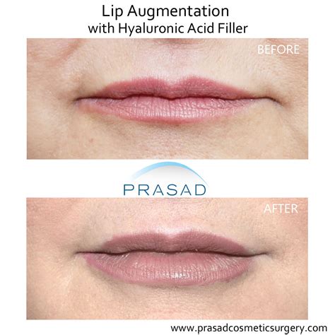 Lip Enhancement Before And After Photos Prasad Cosmetic Surgery
