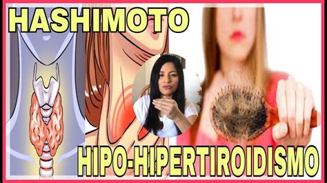 Diferencia Entre Hashimoto Hipotiroidismo E Hipertiroidismo Youtube