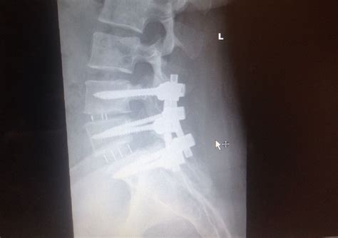 Three Level Spinal Fusion Mapasgmaes