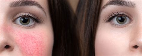 Lupus Rash Vs Rosacea The True Cause Of Facial Redness Luv68