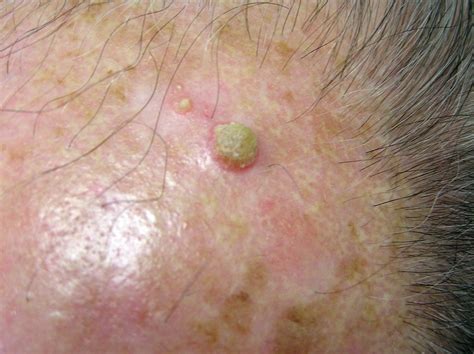Actinic Keratoses Pictures Pictures Photos