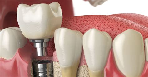 Single Tooth Replacement Cvf Dentistry
