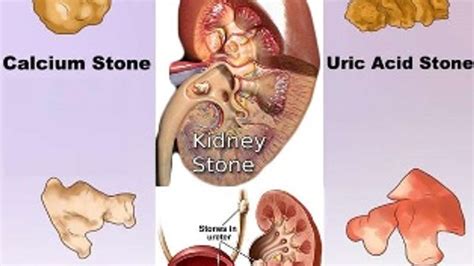Types Of Kidney Stones And Their Symptoms