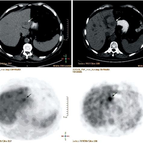 Axial Fused Pet Ct Scans Of The Upper Abdomen Before Right 2005 And