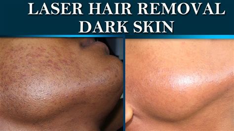 Laser Hair Removal At Dermalogics Before And After On Dark Skin Youtube